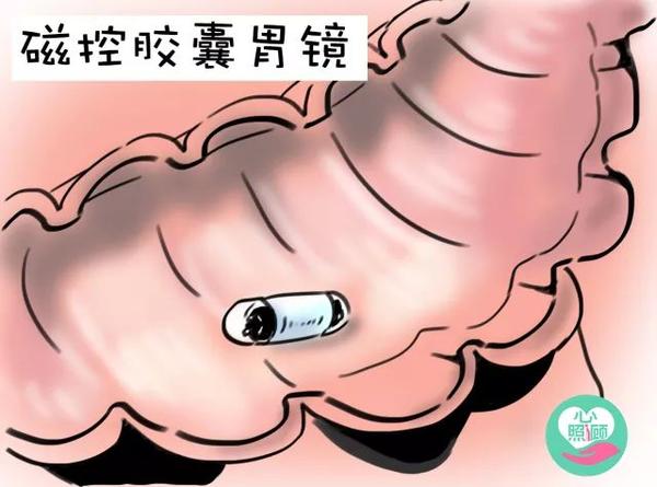 很多对做胃镜心存恐惧的朋友会选择无痛胃镜,但是, 以下情况要慎重