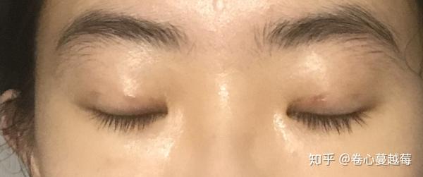 微创/三点式双眼皮恢复记录(含术后三个月微调)