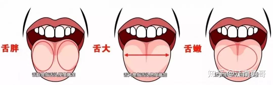 胖舌头:舌头肥大是湿气过重的症状,而脾脏是代谢湿气的脏器,表现脾胃