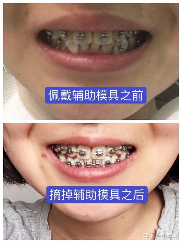 图八.牙齿咬合时,下切牙露出部分显著增大.