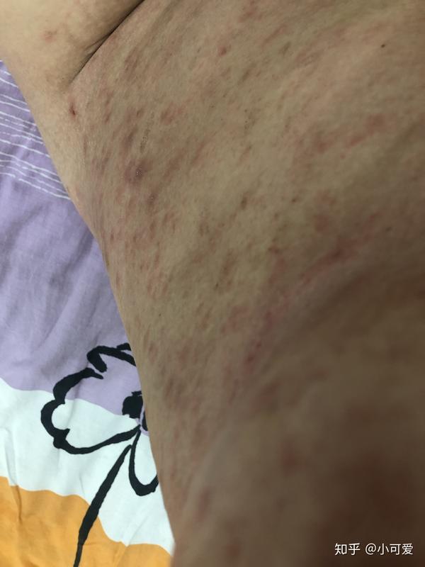 我来说一说,我的玫瑰糠疹的经历吧,因为不会玩知乎,希望宝宝们快点好