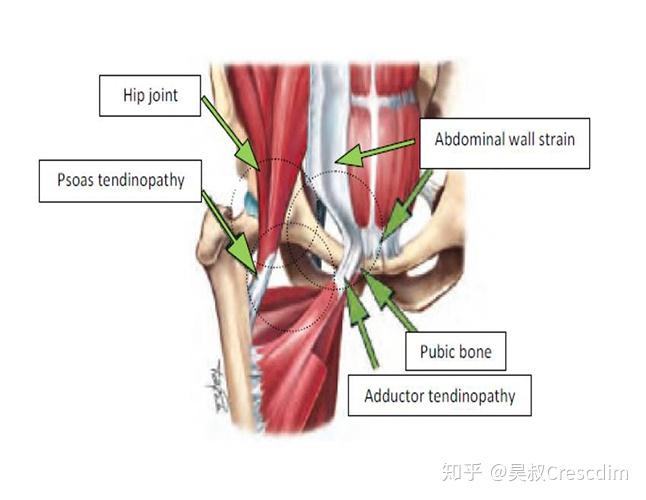 大腿内收肌拉伤引起腹股沟疼痛如何进行自我康复