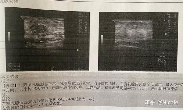 记录一下乳腺4a结节伴钙化全过程.微创手术时正好例假