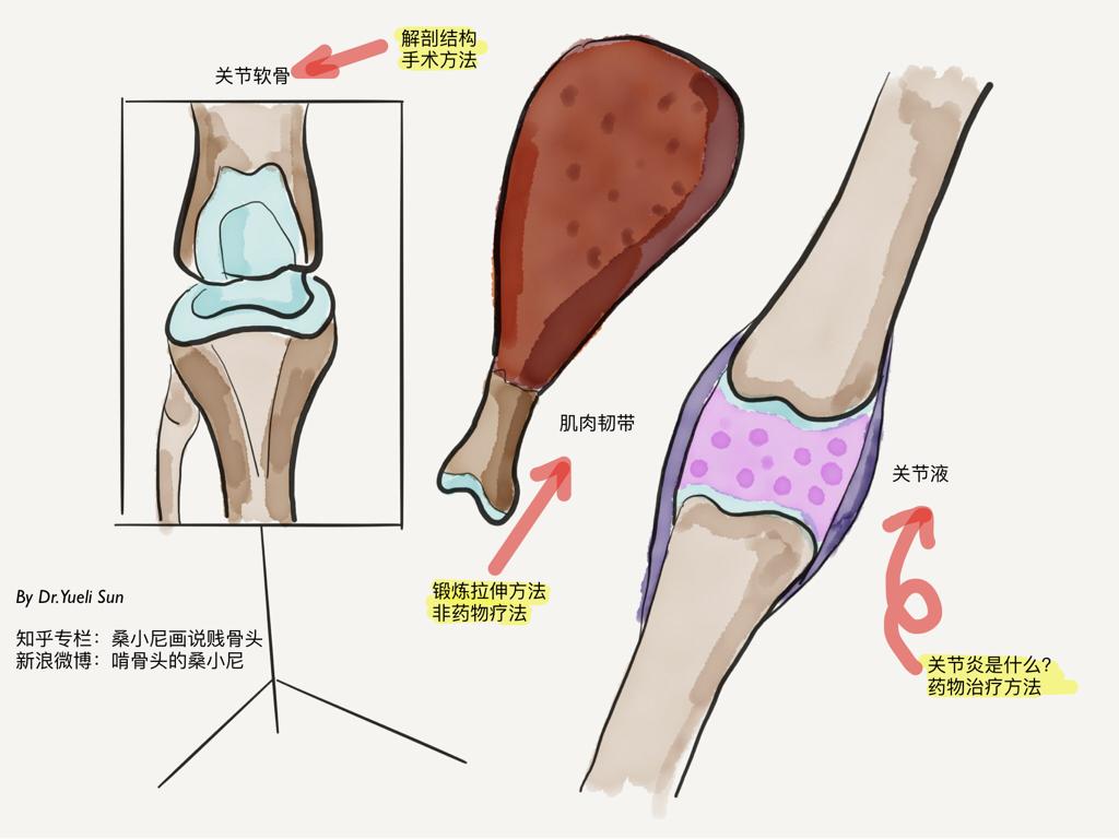 重新认识「膝骨关节炎」——手绘插图多到爆炸的一期