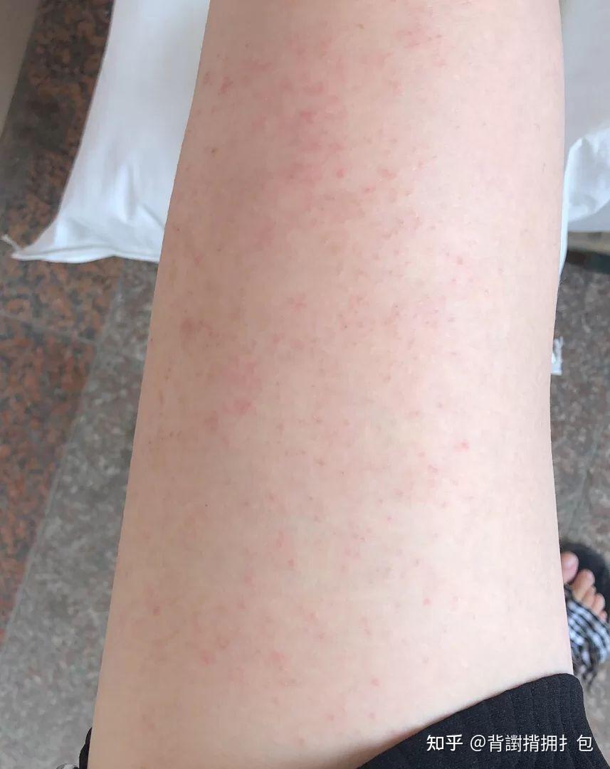 每年夏天都起湿疹是怎么回事