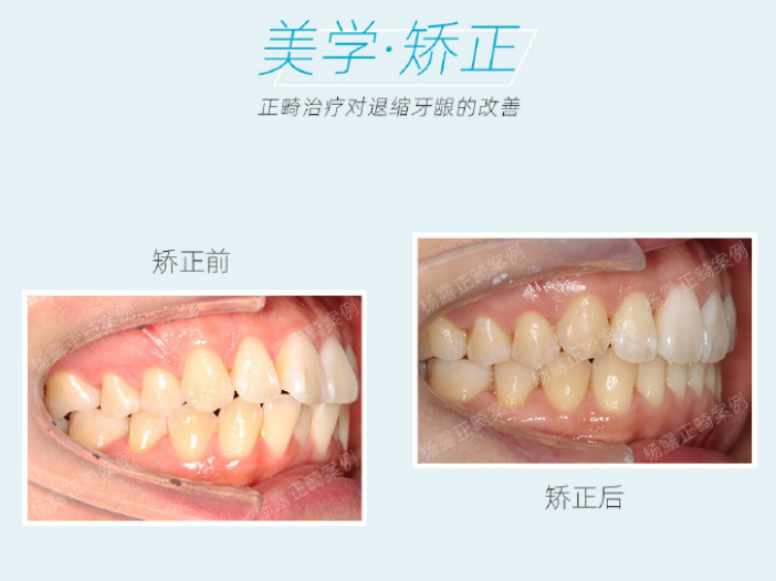 整牙后,我们可以看到牙龈已经长出来一些了,而且变得比较薄了,基本上