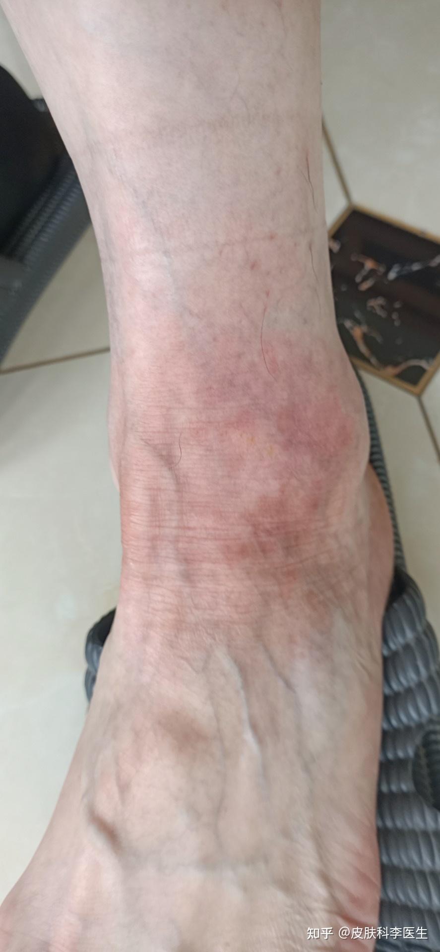 某男 57岁 江苏患者,左脚踝部慢性湿疹并神经皮炎,苔藓样改变,15余年