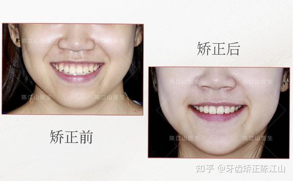 会建议有些患者在正畸治疗过程配合唇肌训练,微笑训练,改变肌肉发力