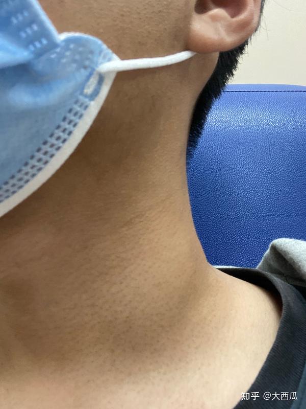 右侧脖子有点疼,可能是口腔溃疡引起的 过了两个礼拜,期间 在右侧脖子