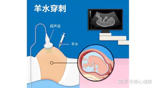 nipt无创dna检查与羊水穿刺的对比,选哪个?