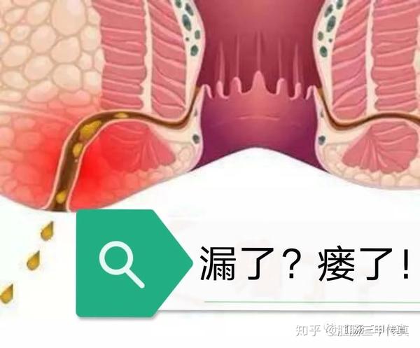 肛周脓肿之后为什么还要做肛瘘手术