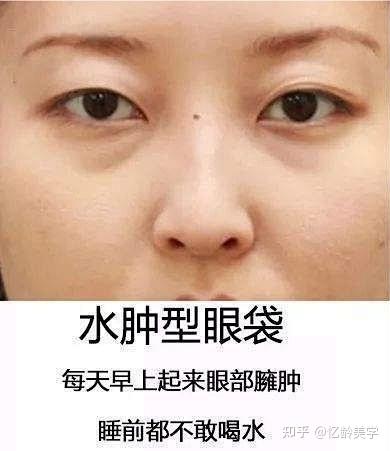 1,水肿型眼袋 这就是典型的"假性眼袋",是由于作息不规律或睡前喝水