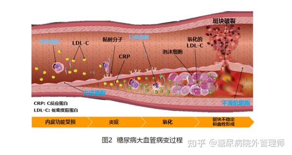 动脉粥样硬化斑块的破裂又可以引发中风,心肌梗死等心脑血管事件.