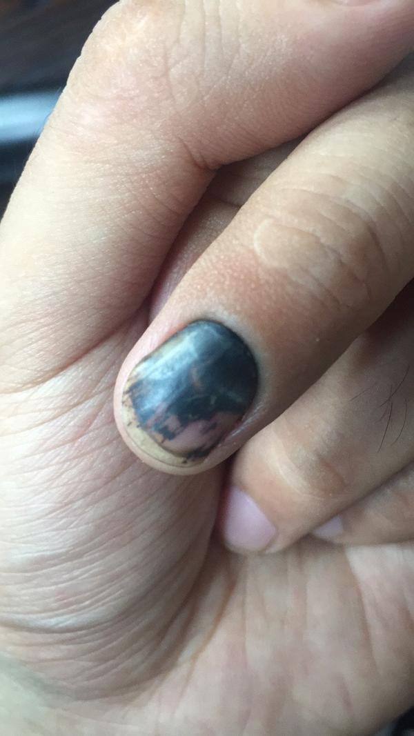 请问我的指甲被锤子砸了,几个月了,能长出新指甲吗?
