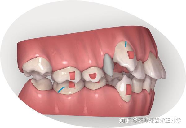 天津牙齿矫正|正畸中的二类牵引有什么用?——基础篇