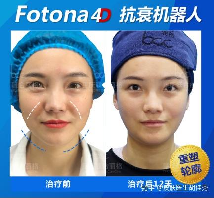 风头盖过热玛吉的fotona4d到底有什么用