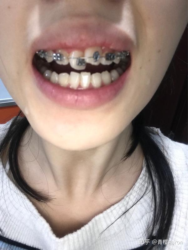 嘴合不上,而且笑起来嘴歪