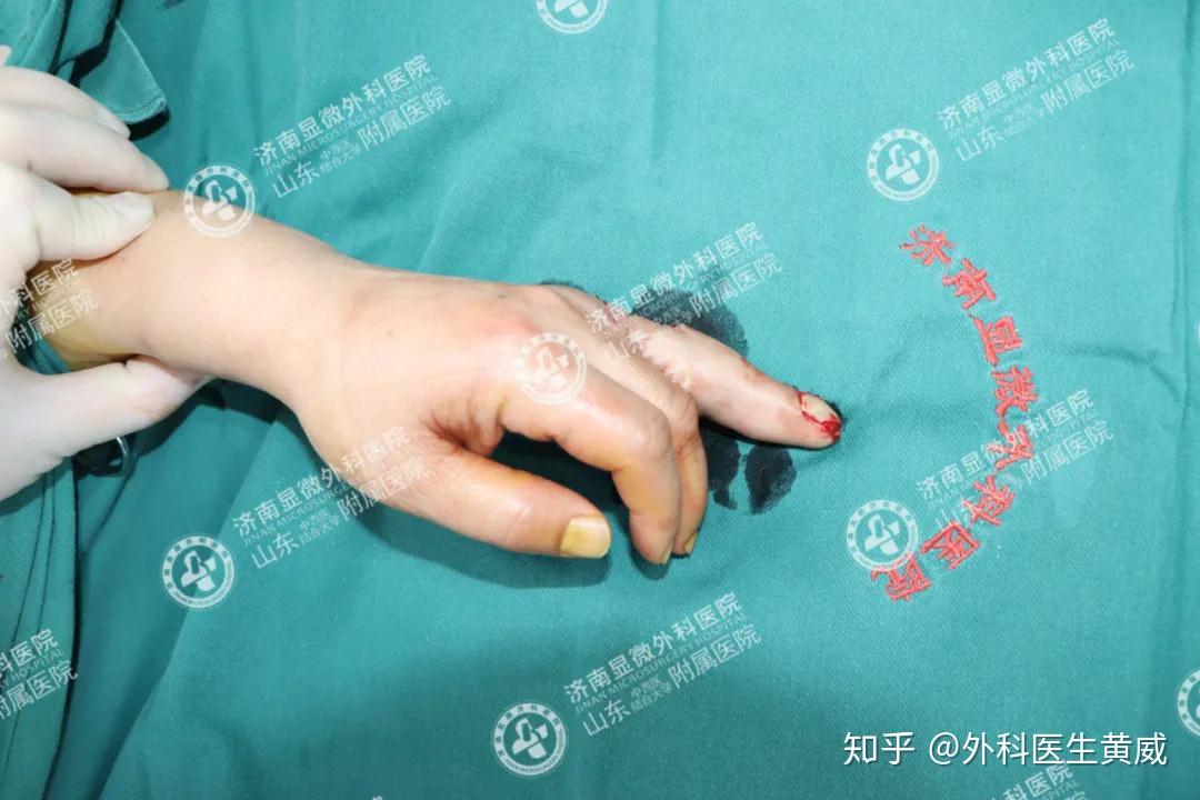 【断指重生】医生奋战11小时再造手指,只为守住患者生活的希望!