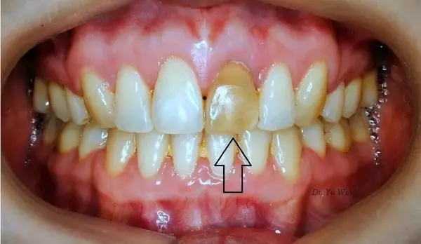 牙髓坏死会导致牙齿变棕黄进而发黑