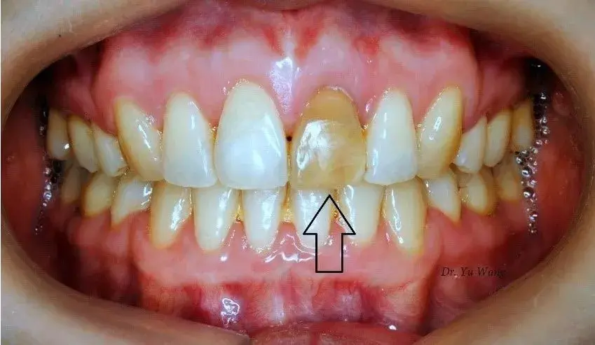 牙髓坏死:因外伤或感染等原因导致的牙髓坏死,会导致牙齿变棕黄进而发