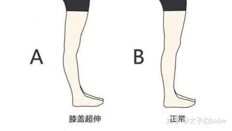 什么是膝过伸 - 知乎