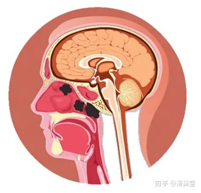 清鼻堂科普:鼻窦炎为什么青睐年轻人?
