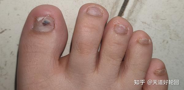 灰指甲吃药治疗过程(单纯记录)