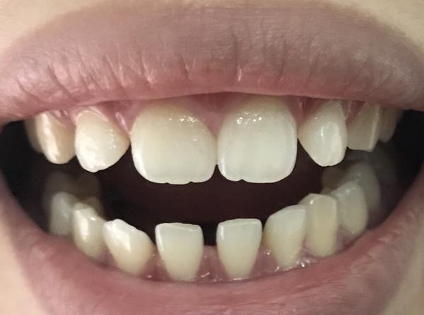 牙齿稀疏,隐形矫正?