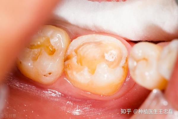 无药可救的坏牙最终还是拔掉了缺牙位置怎么办