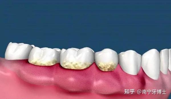 可能造成牙龈炎,牙龈,牙槽萎缩等问题, 严重时甚至可以导致牙齿过早