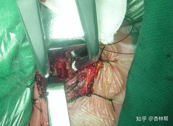 颈椎前路及后路手术需康复注意的问题