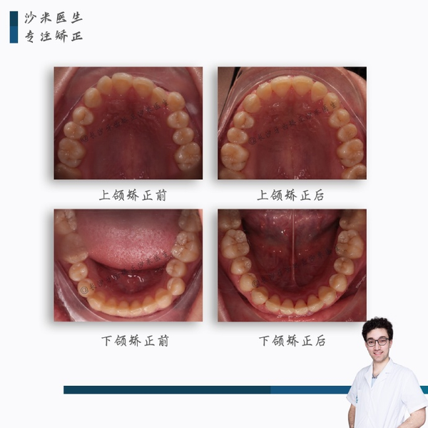 长沙牙齿矫正-沙米医生的案例time