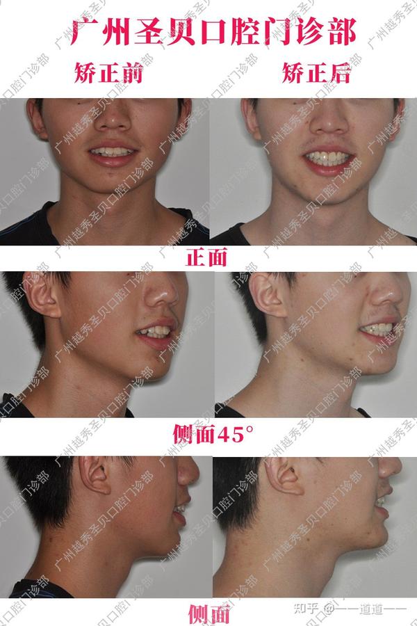 广州圣贝牙齿矫正案例分享牙齿不齐前牙深覆盖治疗