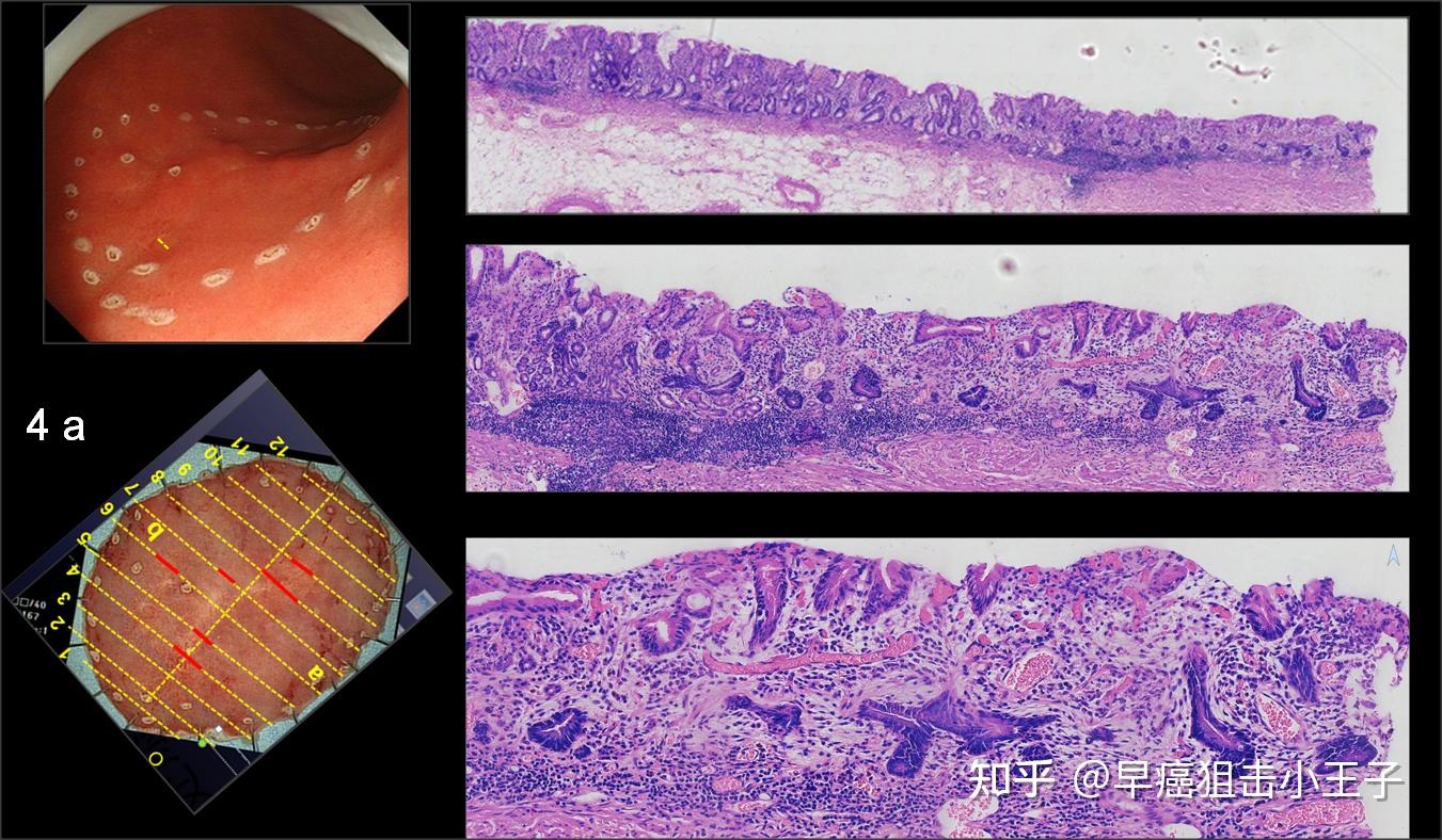 这次用的是低倍77高倍77满倍放大,很明显,放大胃镜下的表现妥妥的