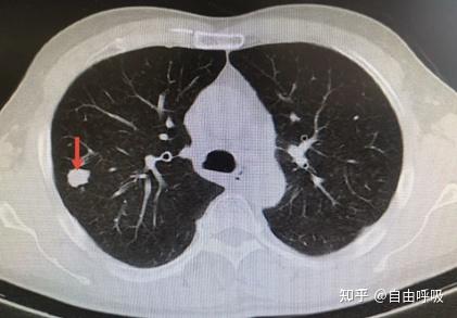 肺结节是什么磨玻璃又是啥