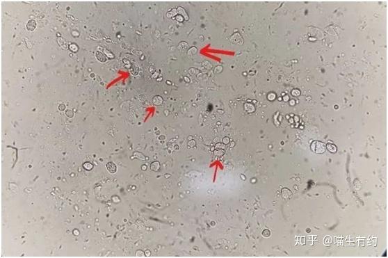 容易被消化腐败而破坏;便便中大量正常形态的红细胞常