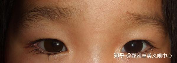 郑州卓美义眼中心专业订做安装义眼(假眼),可以达到以假乱真的效果