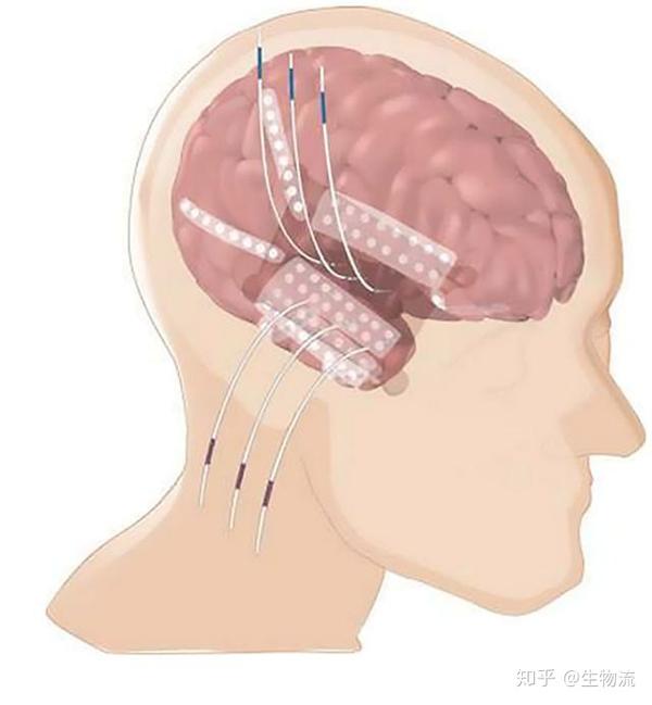 脑内植入电极以定位癫痫灶