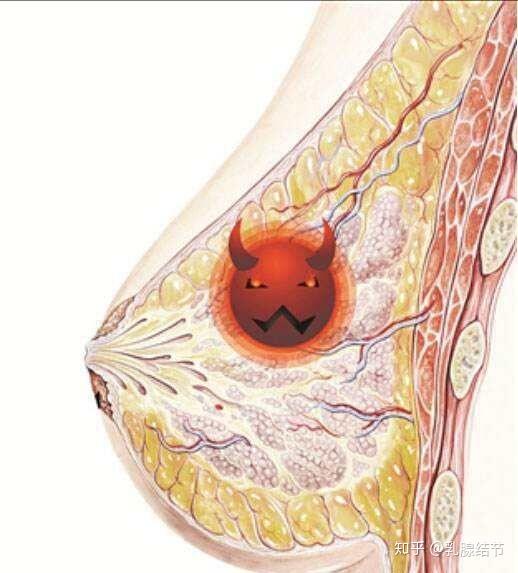 乳腺结节摸起来是什么样的?