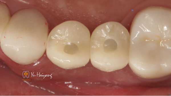 氧化锆冠修复前磨牙连续缺失1例