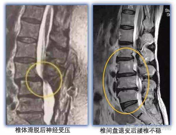 腰痛的元凶----"腰椎不稳定"是怎么回事?