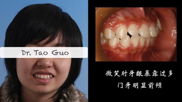青少年龅牙,嘴突矫正案例