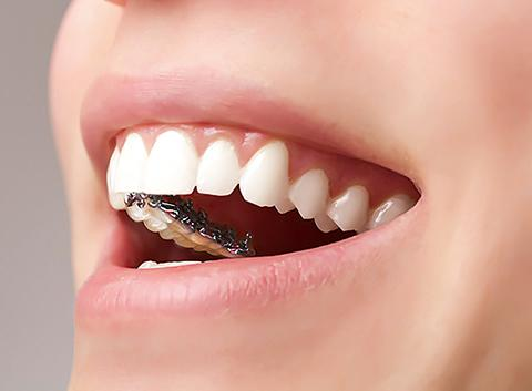 成都牙齿矫正丨整牙有哪些方式费用多少医院能分期吗