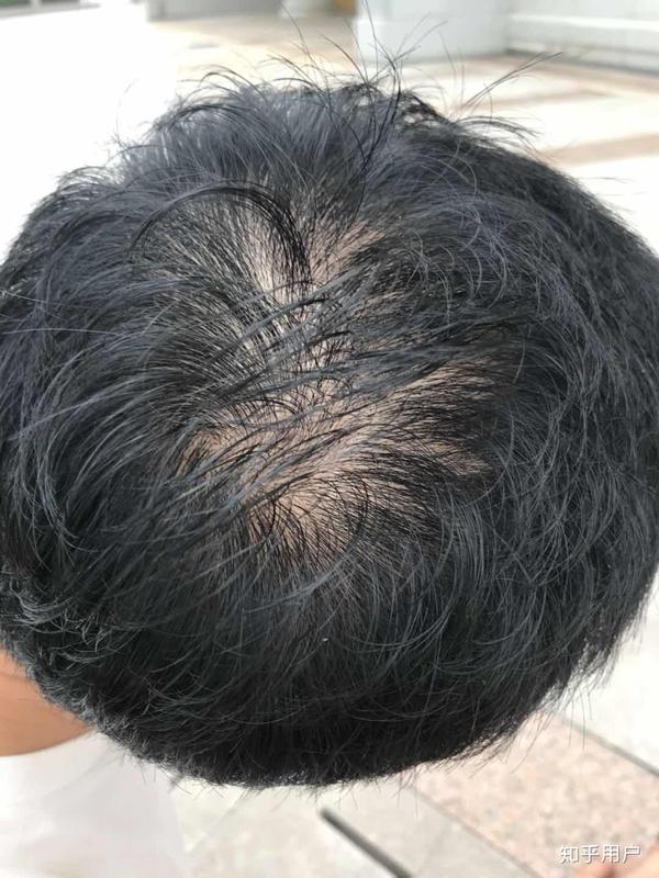 20多岁就秃头是怎样一种体验?