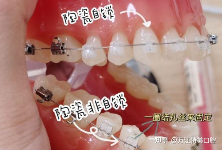 三,陶瓷牙套【适合人群】想要尽快矫正变美,对矫正速度,舒适度有需求