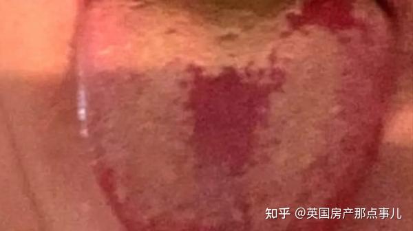 症状一:地图舌