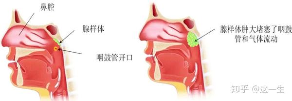 其实,腺样体肥大并不是家长心头大患.