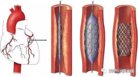 心脏支架