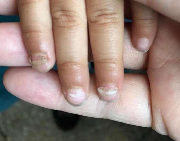 导致指甲出现病变比如这位指甲周围的反复湿疹导致指甲出现甲板变形