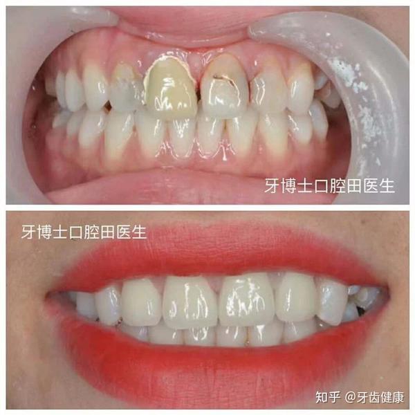 牙齿颜色,形态不好看,牙齿贴面可以帮你一次性解决!